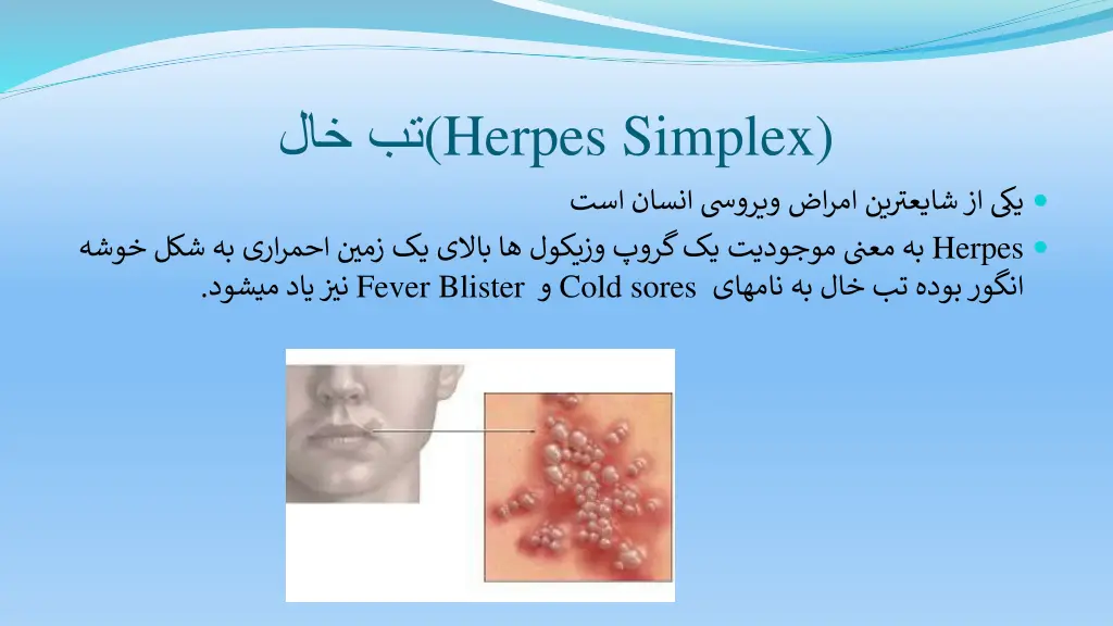 herpes simplex