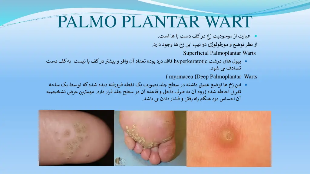 palmo plantar wart