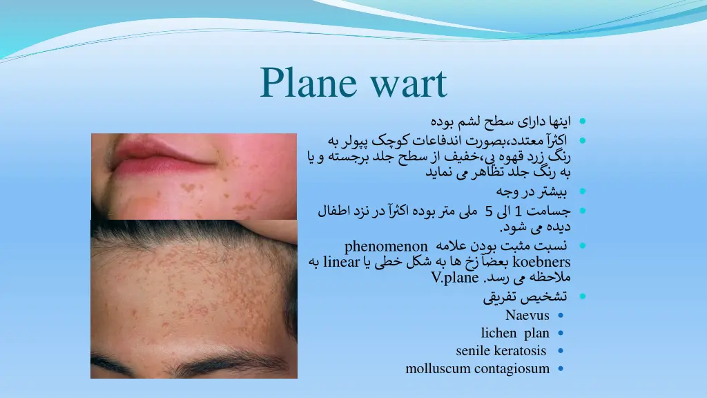 plane wart