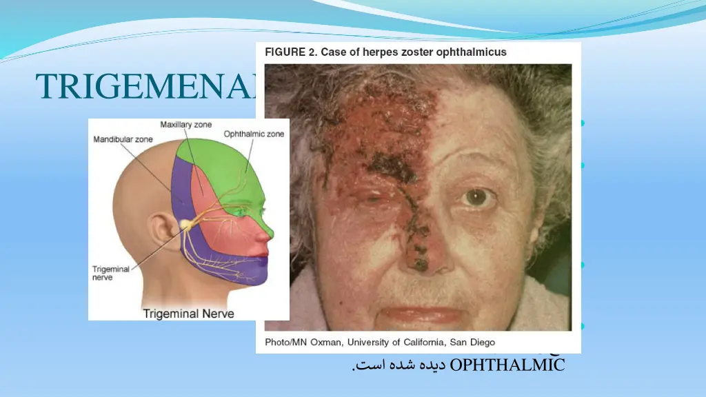 trigemenal