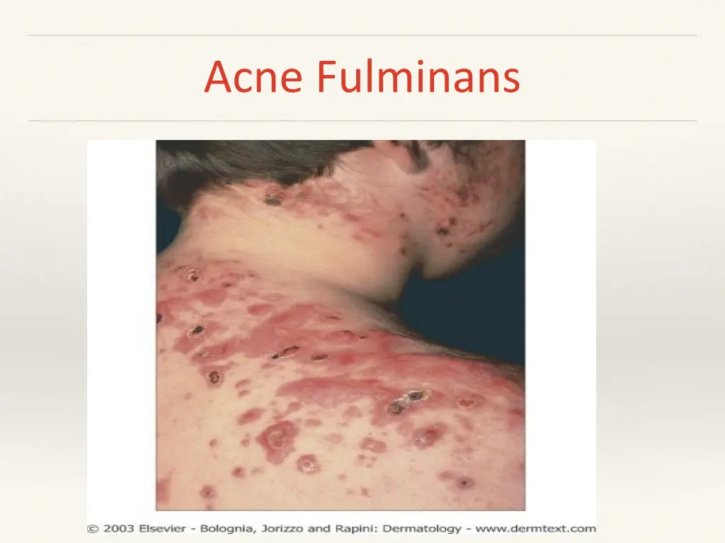 acne fulminans 1