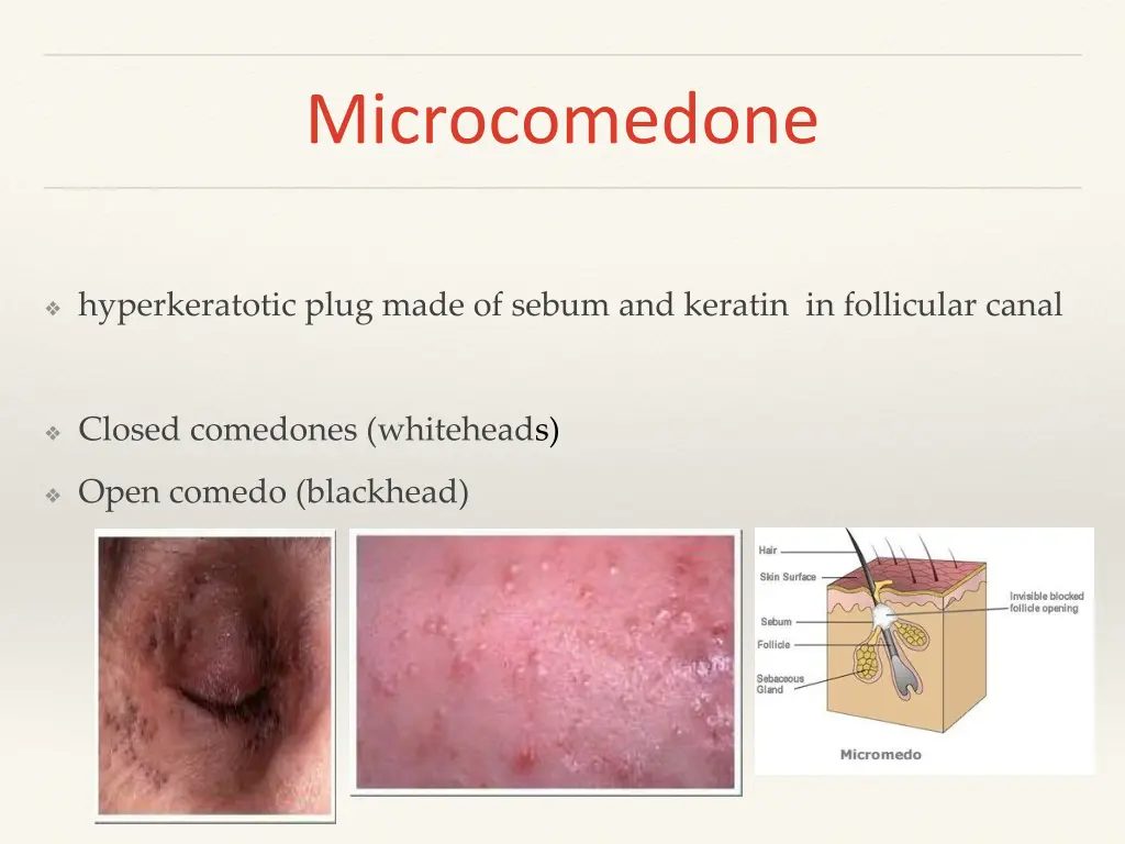 microcomedone