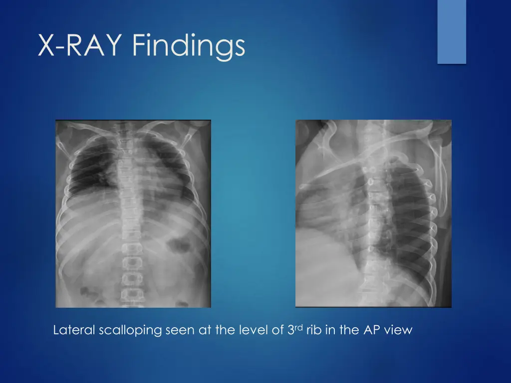 x ray findings