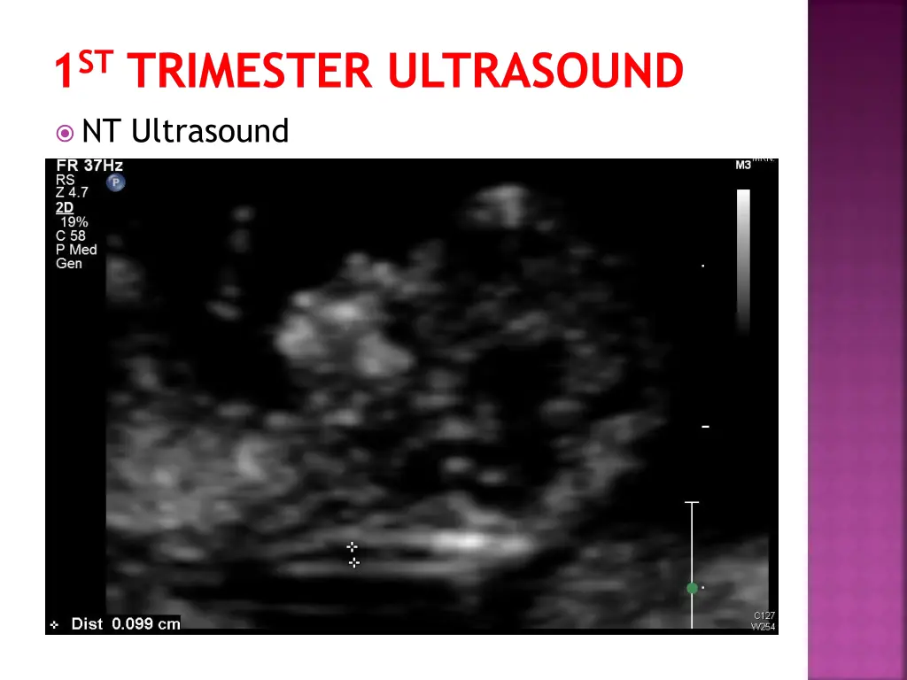 1 st trimester ultrasound