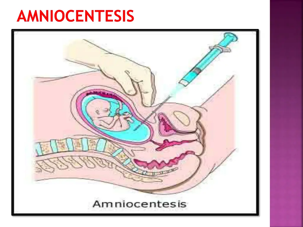 amniocentesis 1