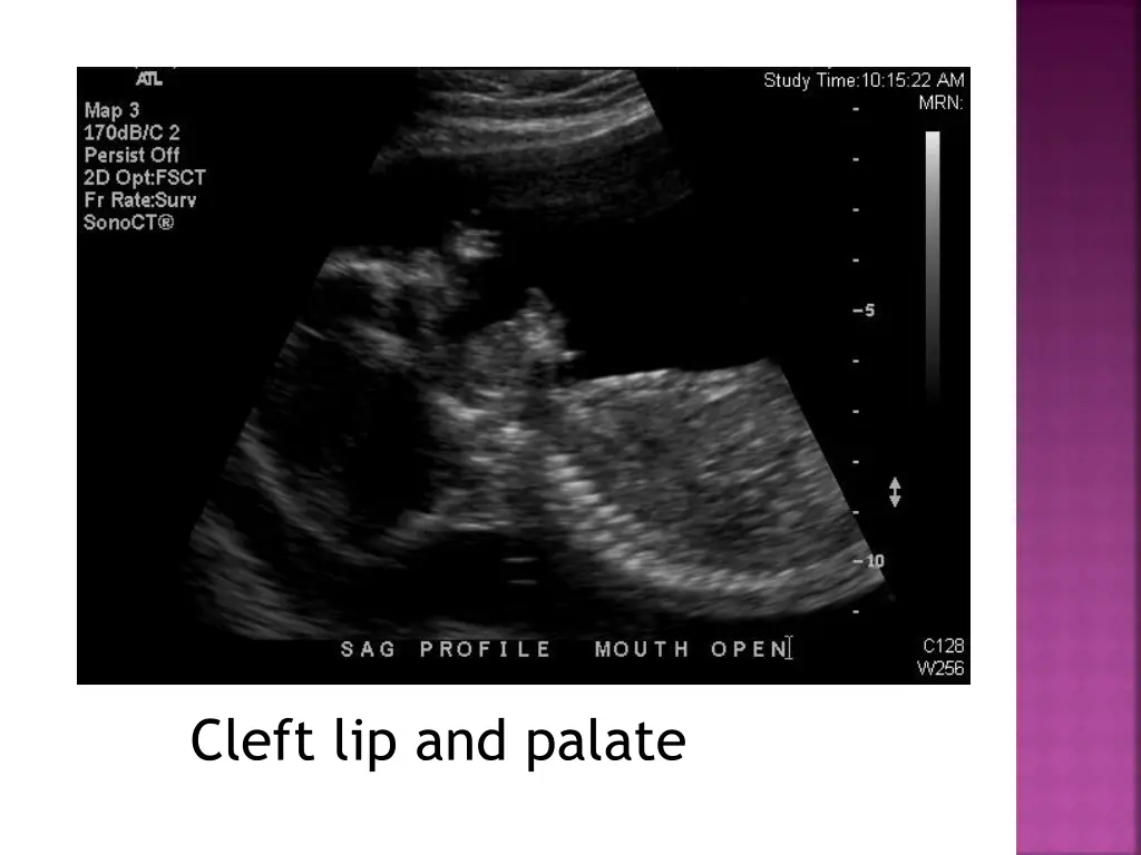 cleft lip and palate