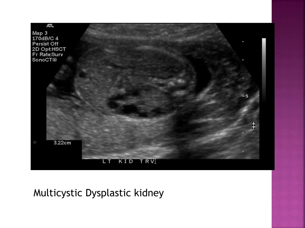 multicystic dysplastic kidney