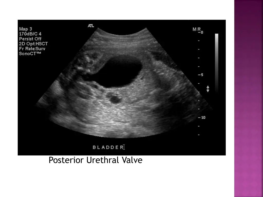 posterior urethral valve