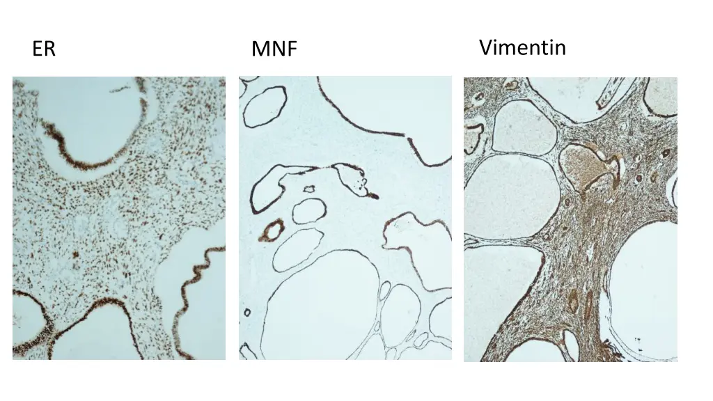 vimentin