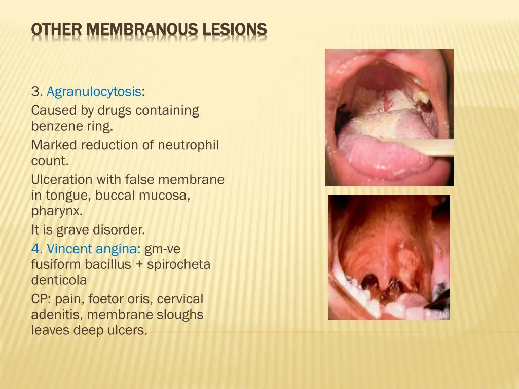 other membranous lesions other membranous lesions