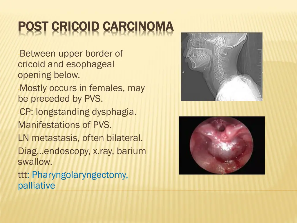 post post cricoid cricoid carcinoma
