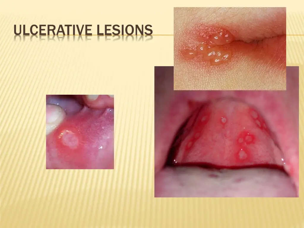 ulcerative lesions