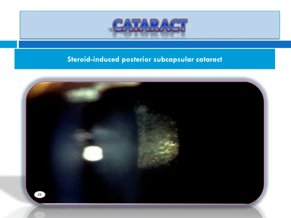 cataract 2
