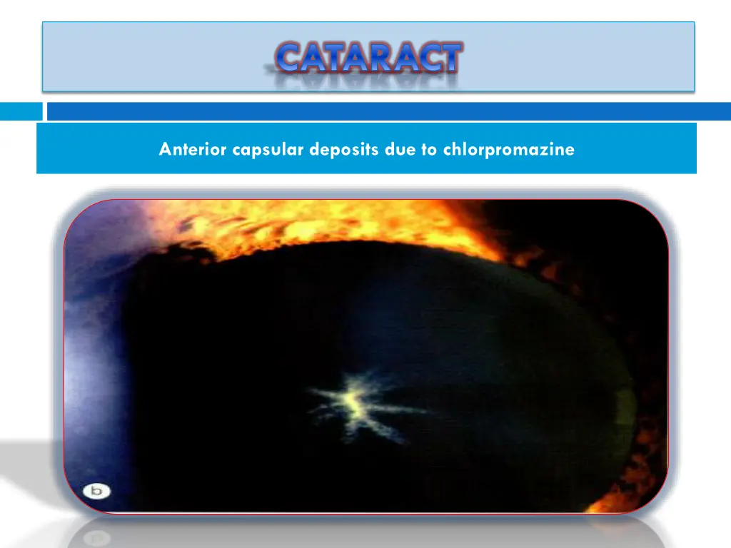 cataract 4