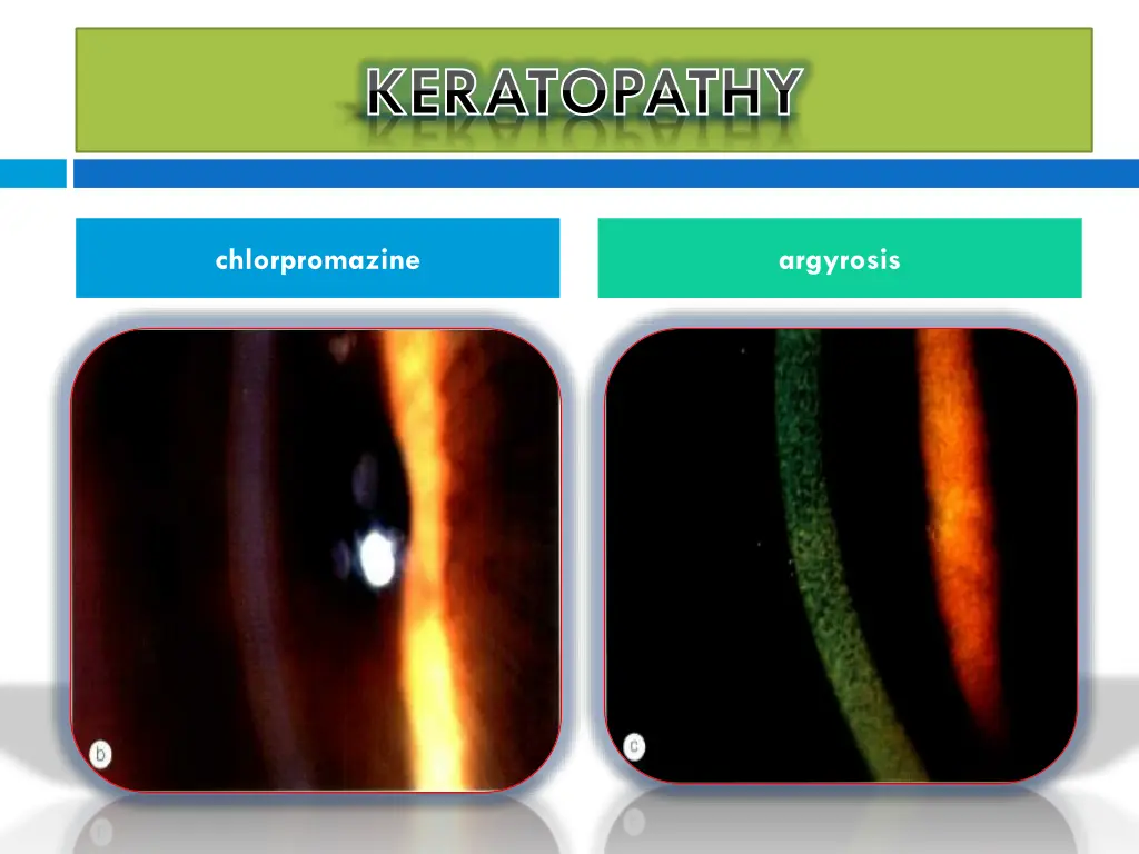 keratopathy keratopathy 3
