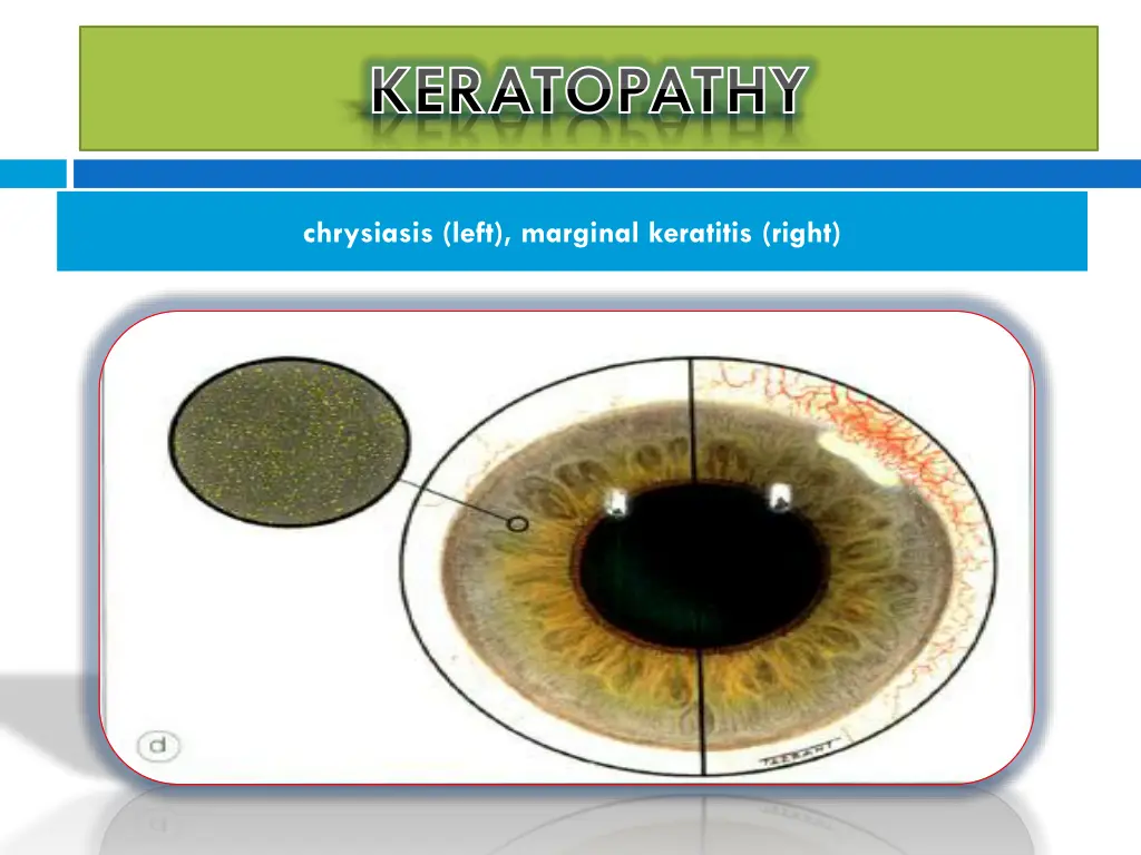 keratopathy keratopathy 5