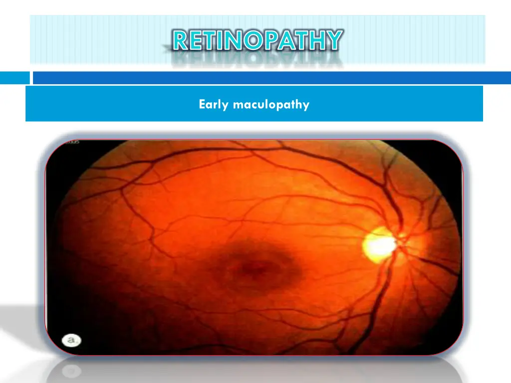retinopathy 6