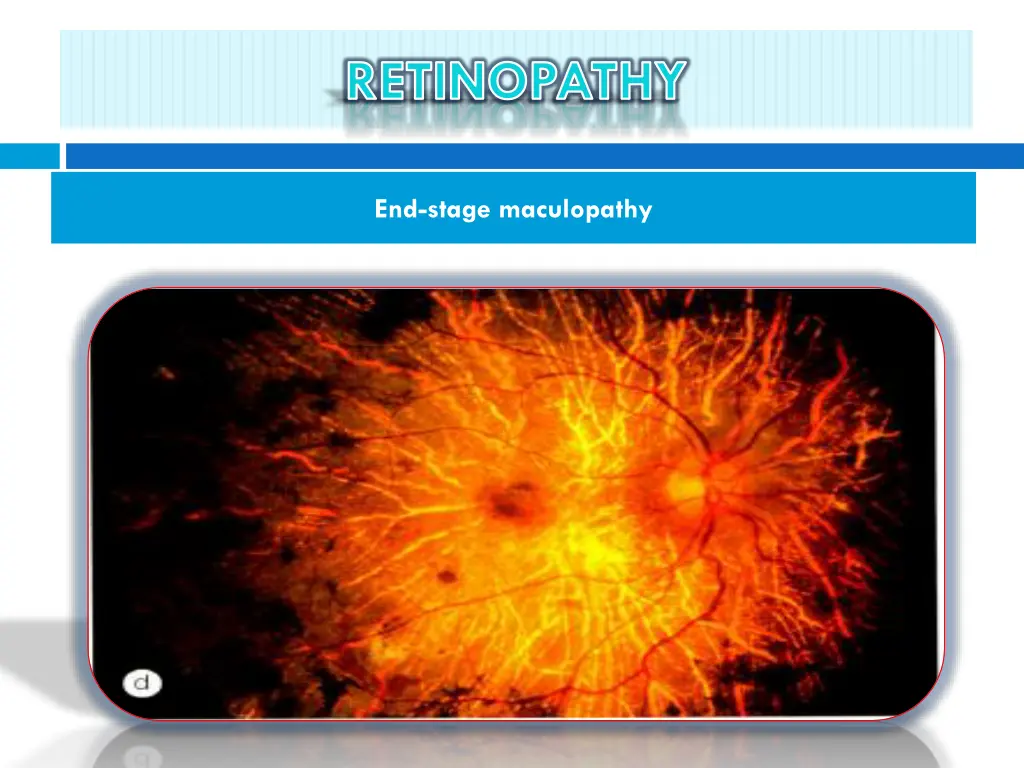 retinopathy 9