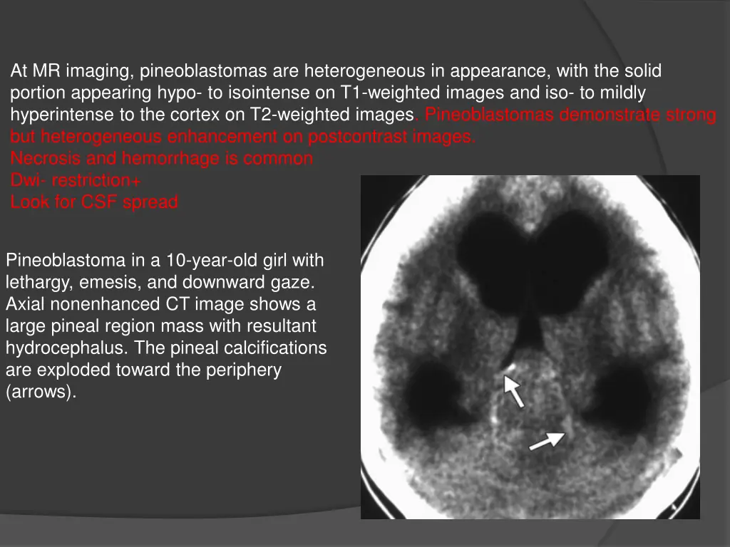 at mr imaging pineoblastomas are heterogeneous