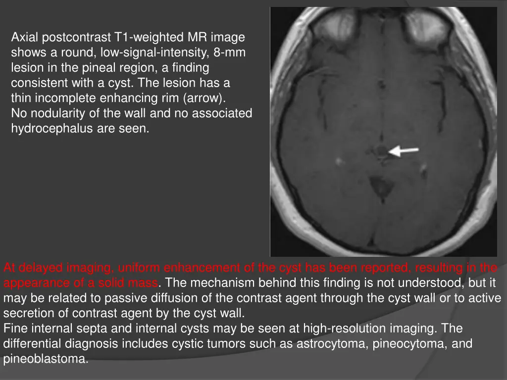 axial postcontrast t1 weighted mr image shows
