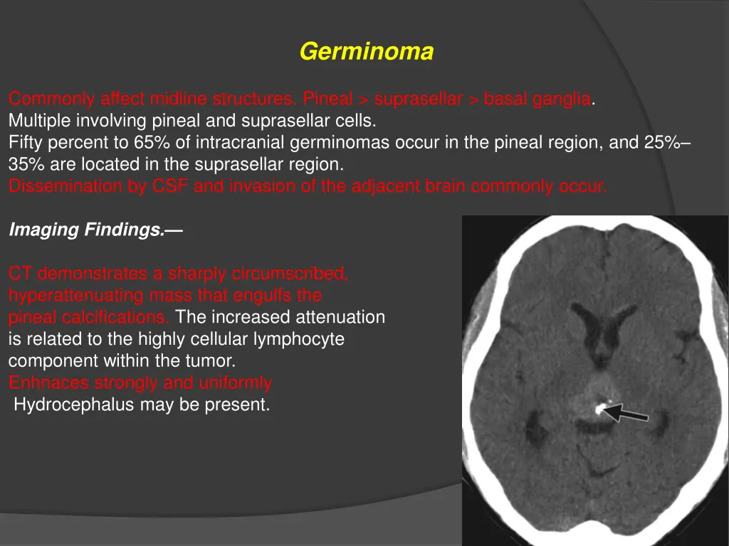 germinoma