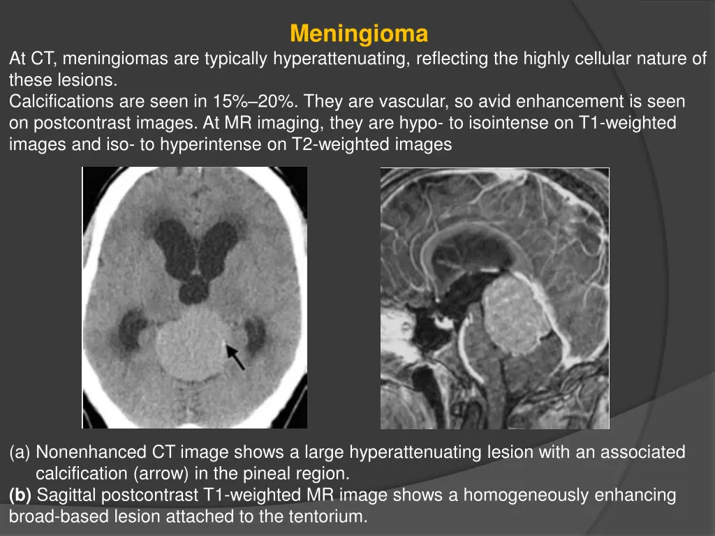 meningioma