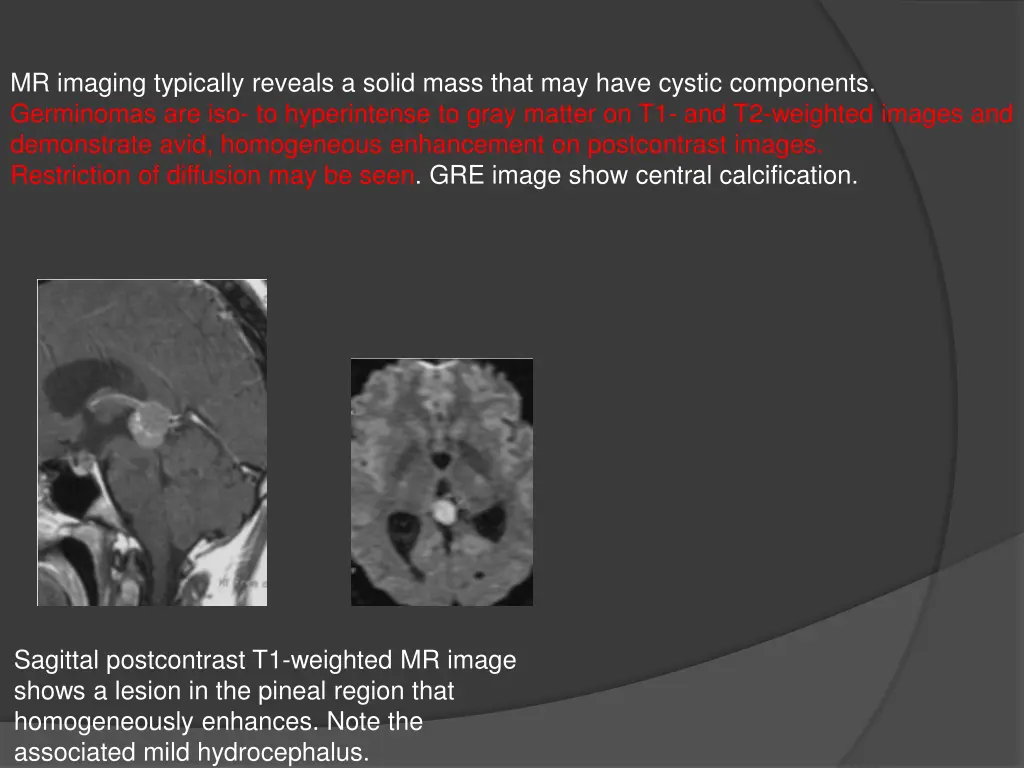 mr imaging typically reveals a solid mass that