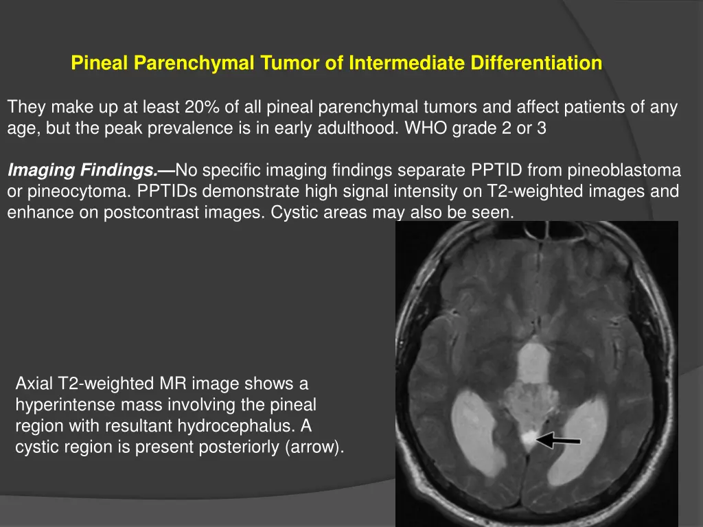 pineal parenchymal tumor of intermediate