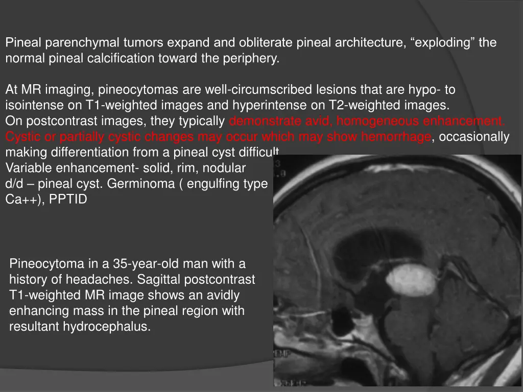 pineal parenchymal tumors expand and obliterate