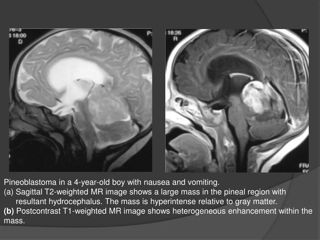 pineoblastoma in a 4 year old boy with nausea
