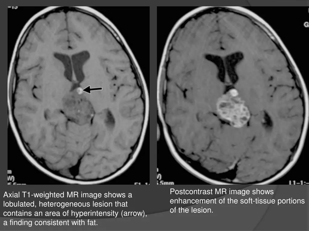 postcontrast mr image shows enhancement