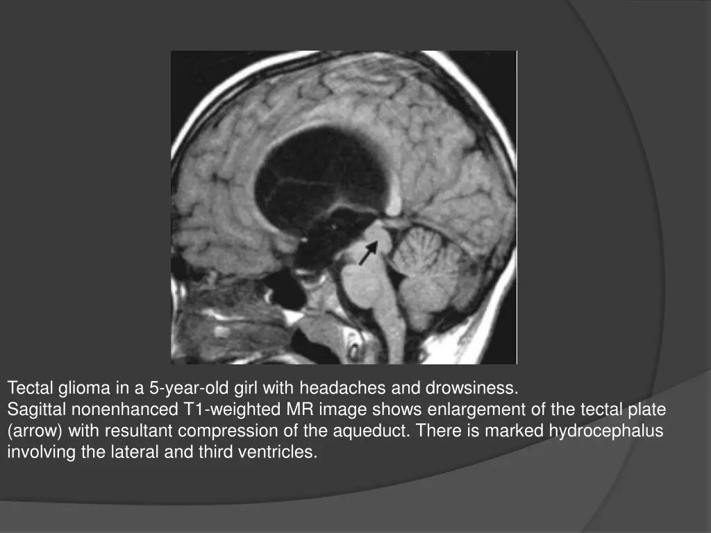 tectal glioma in a 5 year old girl with headaches