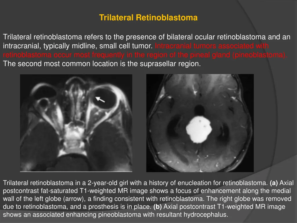 trilateral retinoblastoma