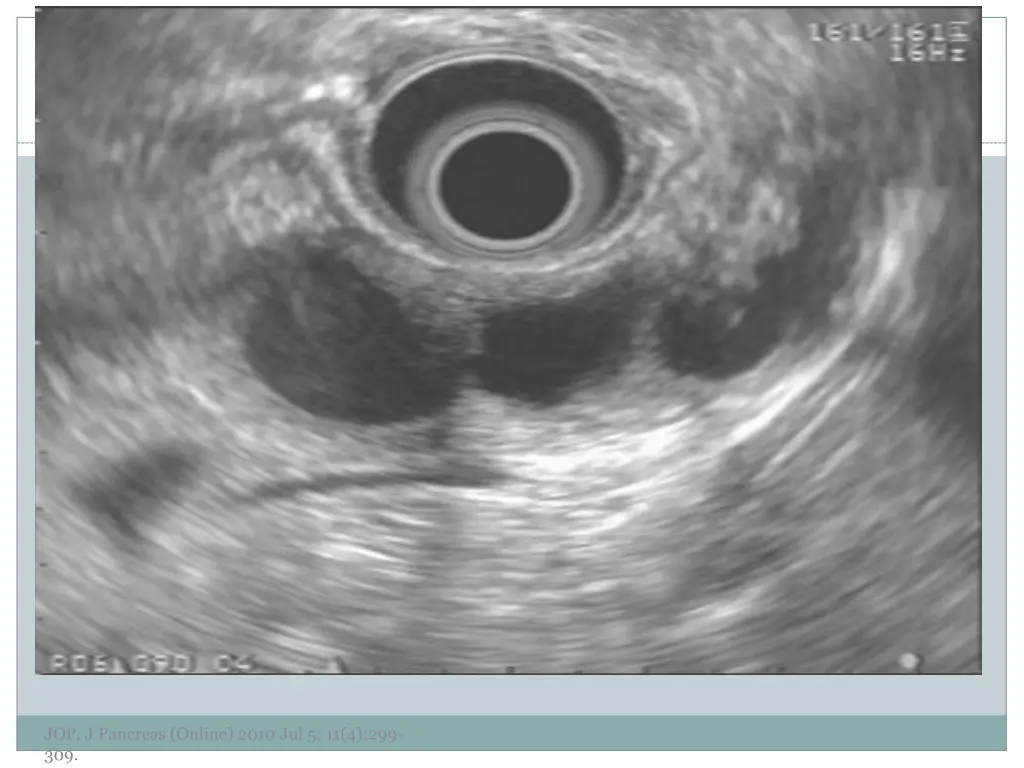 jop j pancreas online 2010 jul 5 11 4 299 309 2