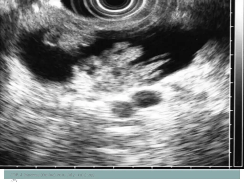 jop j pancreas online 2010 jul 5 11 4 299 309 3