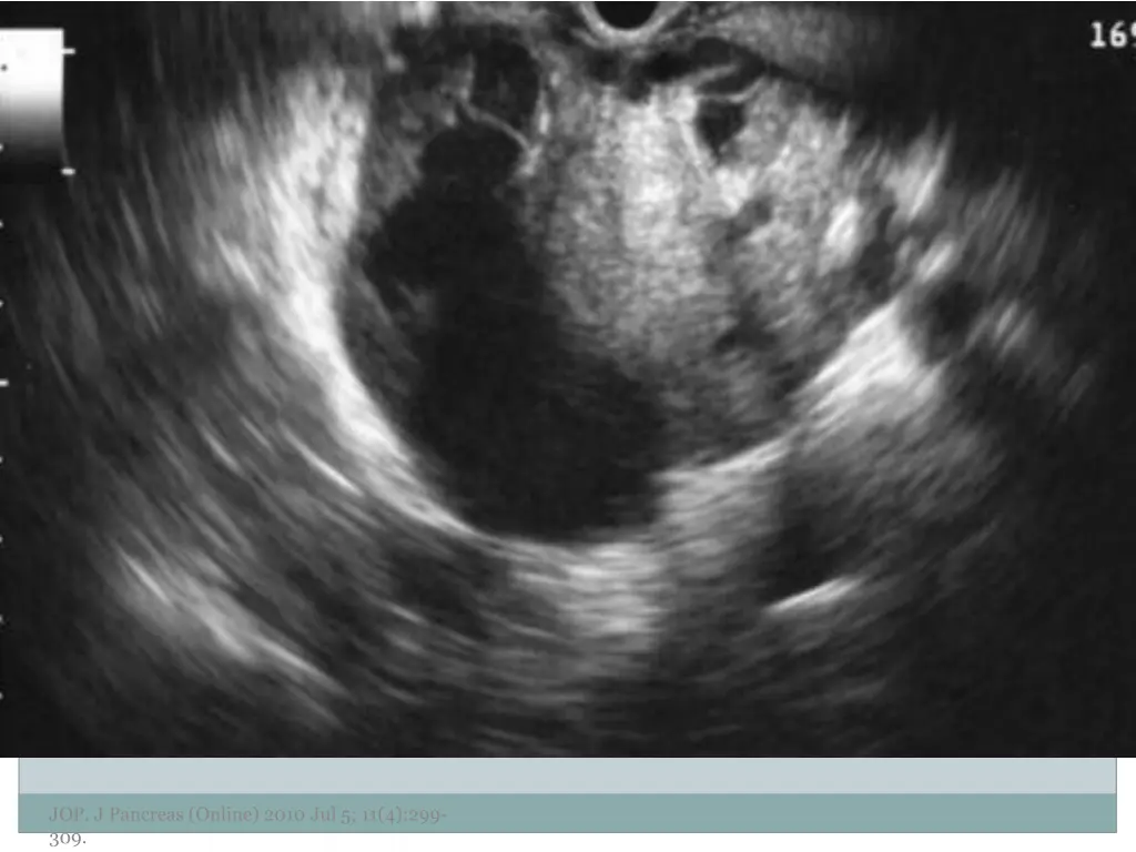 jop j pancreas online 2010 jul 5 11 4 299 309