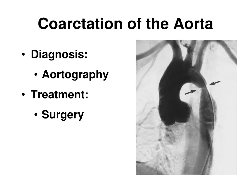 coarctation of the aorta 2