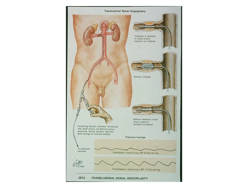 slide14