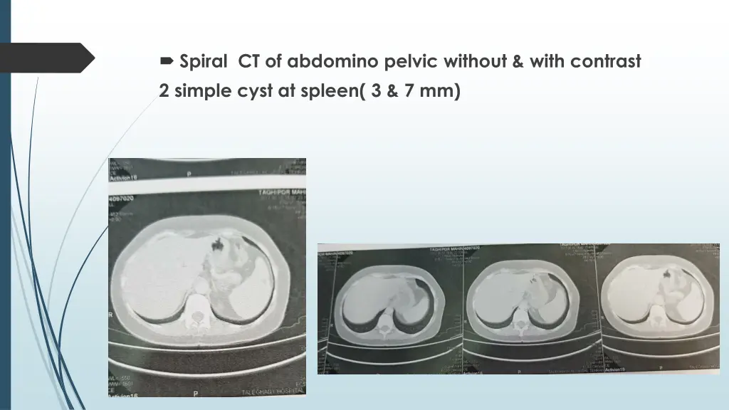 spiral ct of abdomino pelvic without with