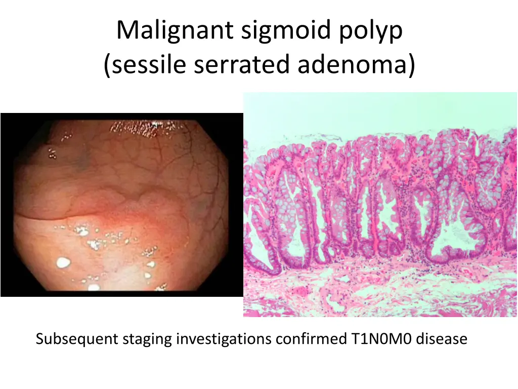 malignant sigmoid polyp sessile serrated adenoma