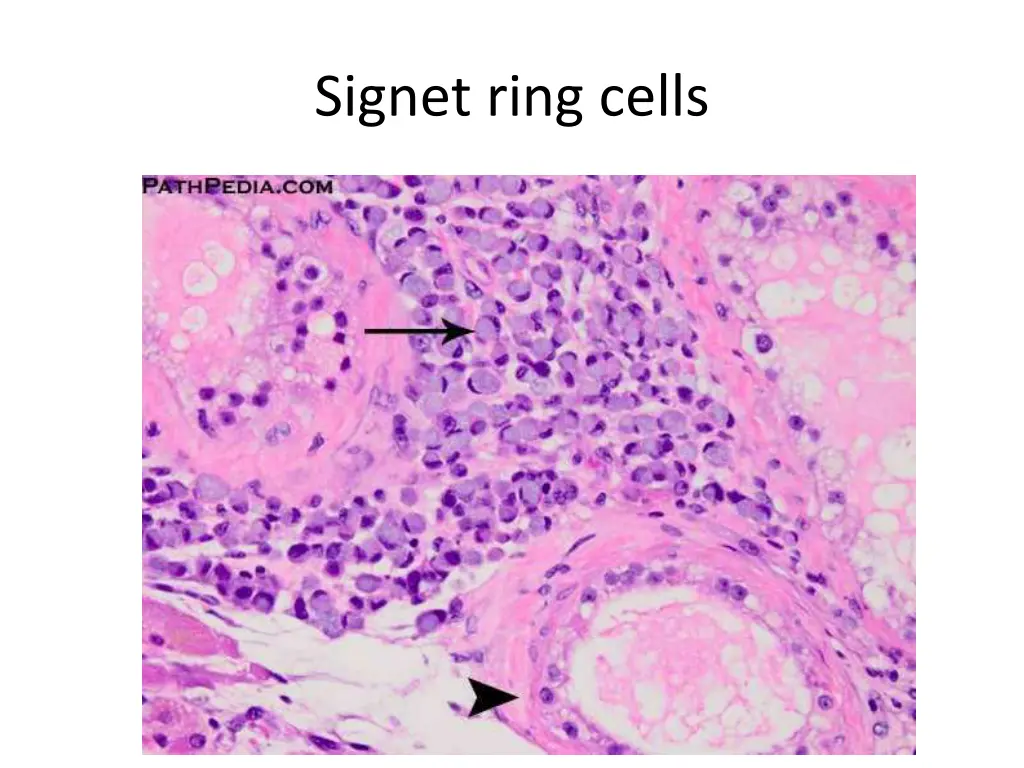 signet ring cells