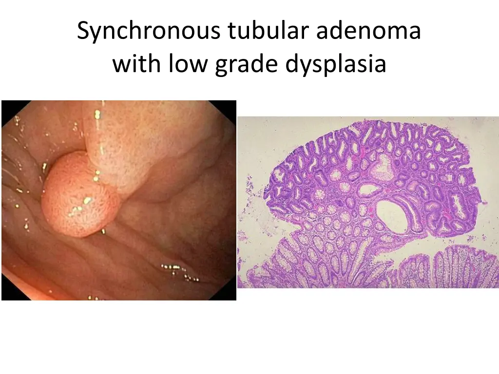 synchronous tubular adenoma with low grade