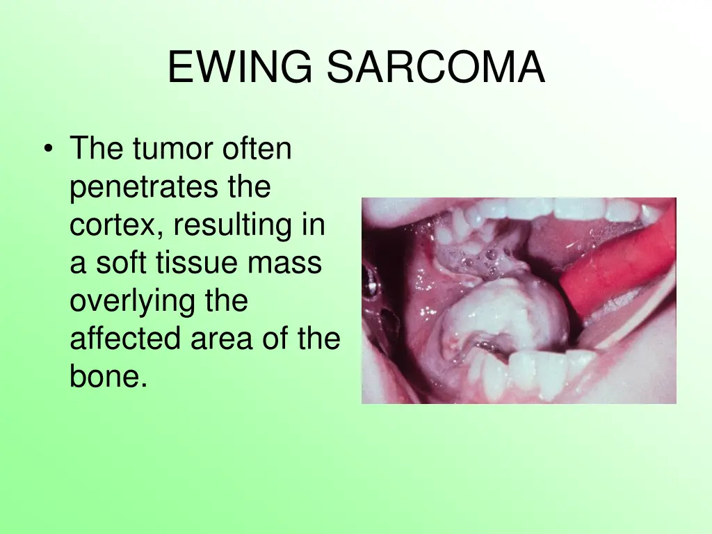 ewing sarcoma 4