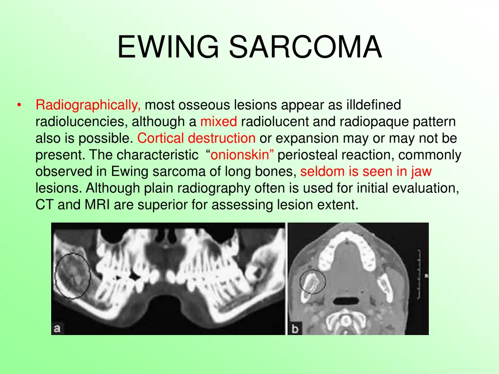 ewing sarcoma 5