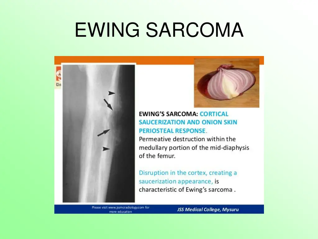 ewing sarcoma 6
