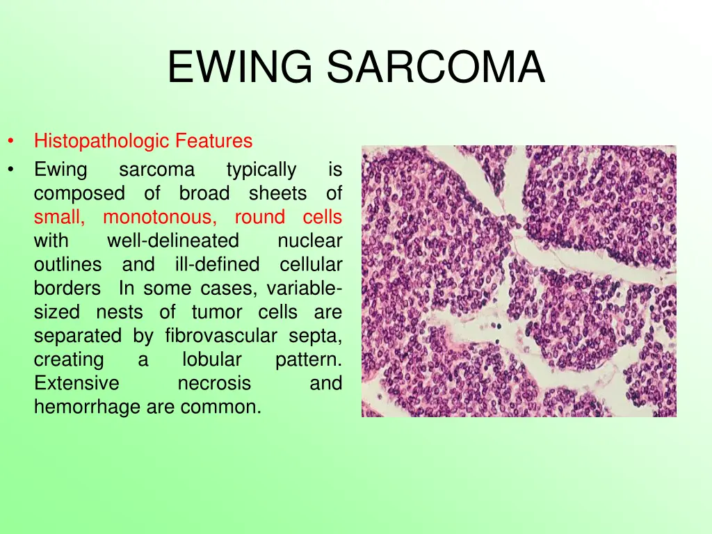 ewing sarcoma 7