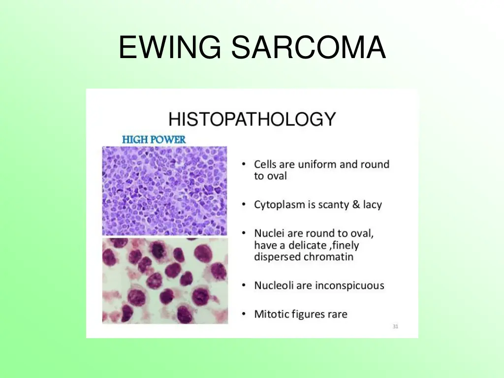 ewing sarcoma 8