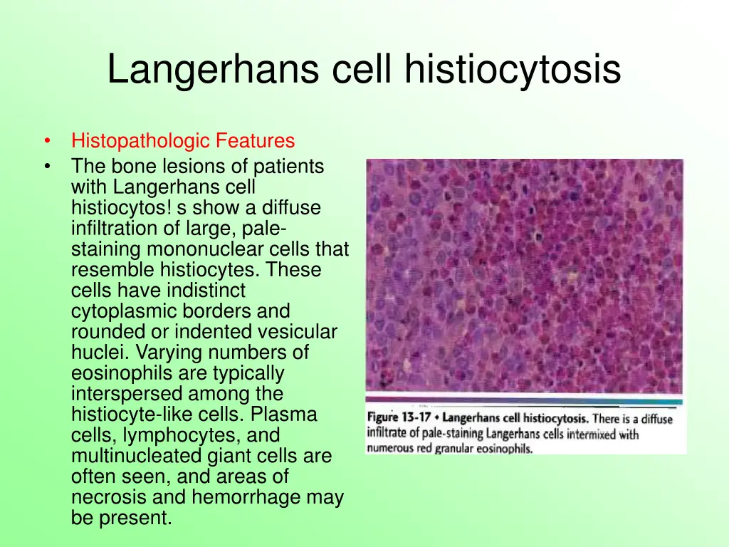 langerhans cell histiocytosis 4