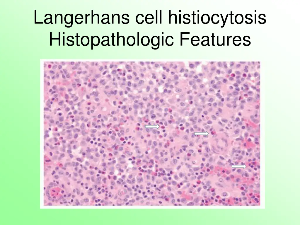 langerhans cell histiocytosis histopathologic 1