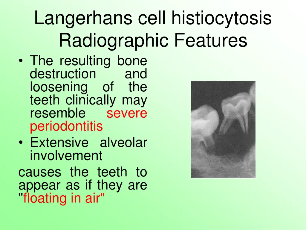langerhans cell histiocytosis radiographic 1